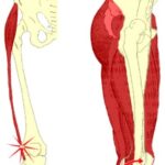 aa51iliotibialis